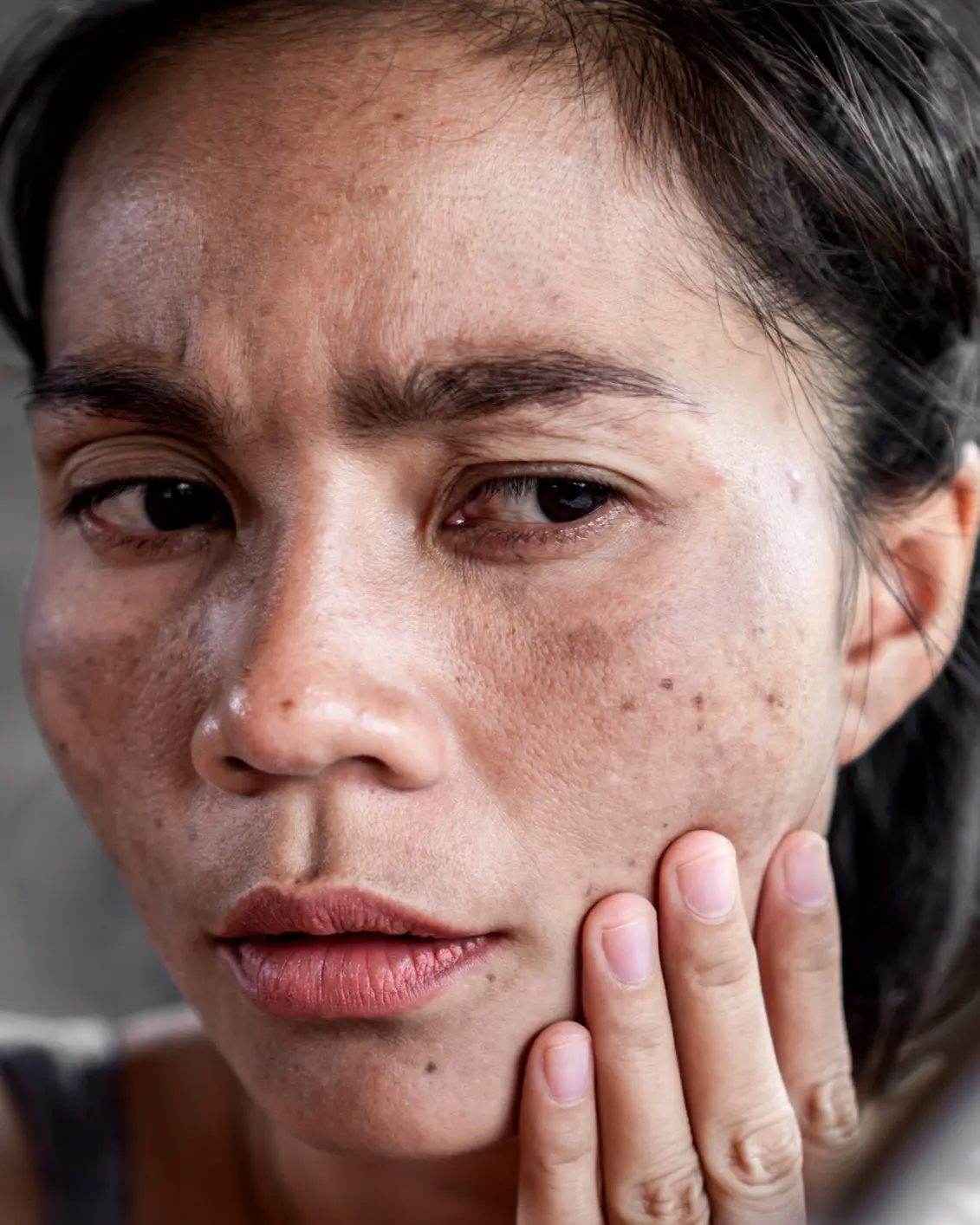 Woman with skin imperfections touching face