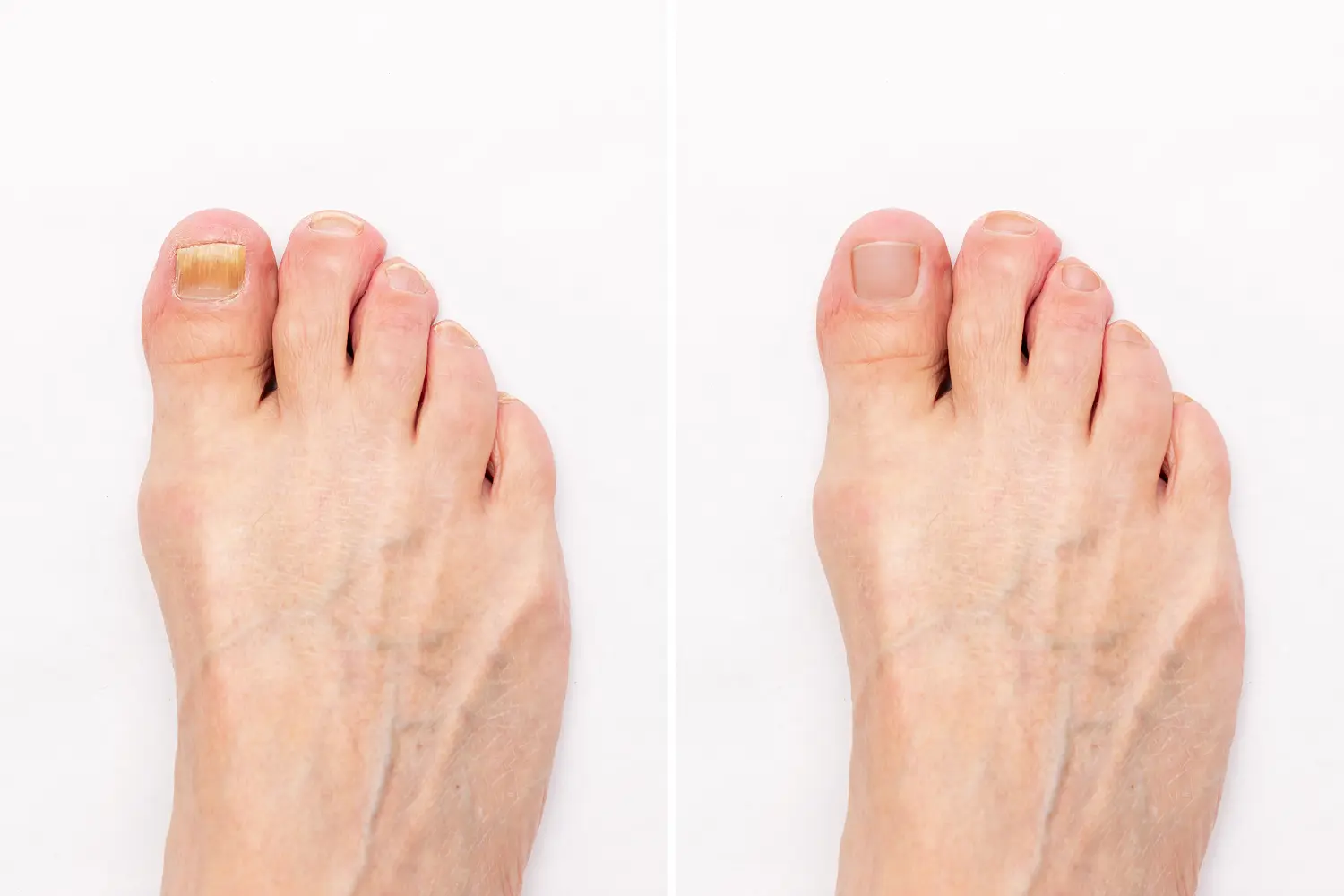 Toenail fungus before and after treatment