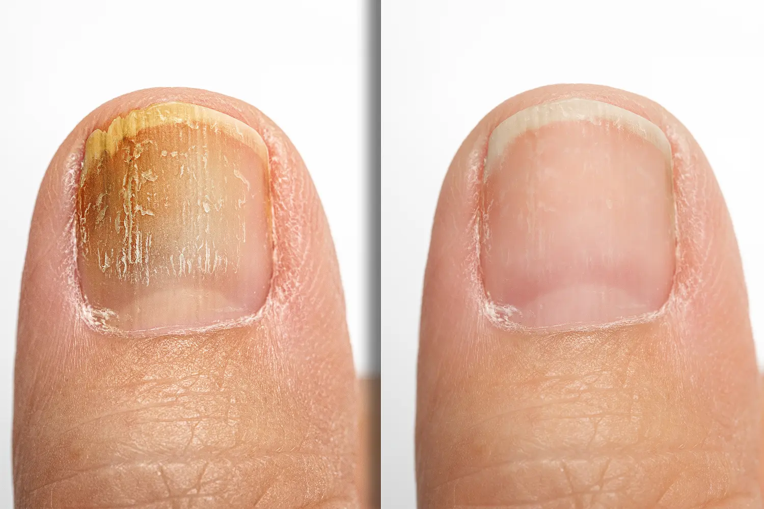 Toenail healing transformation visualized