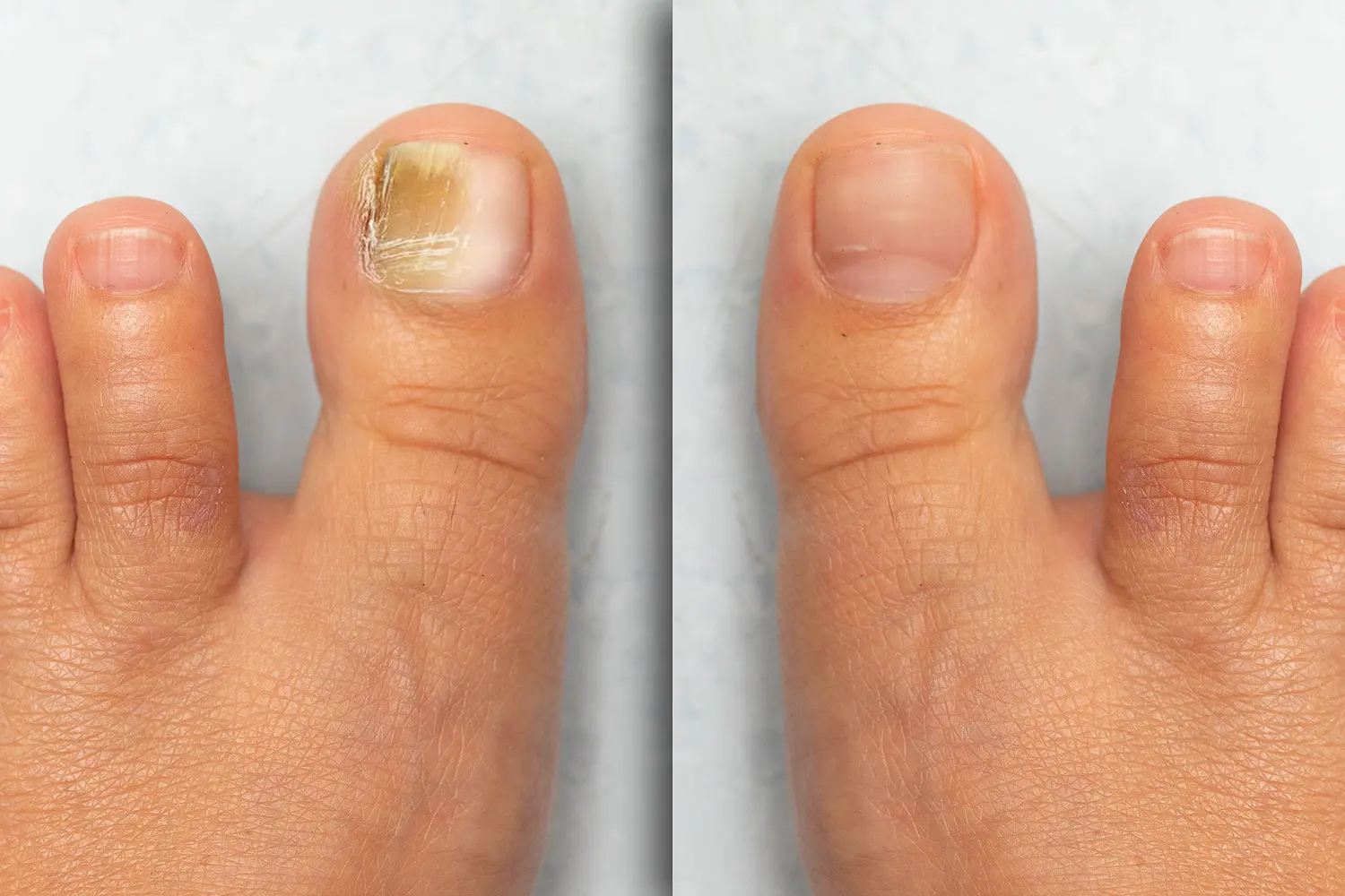 Comparison of infected and healthy toenail