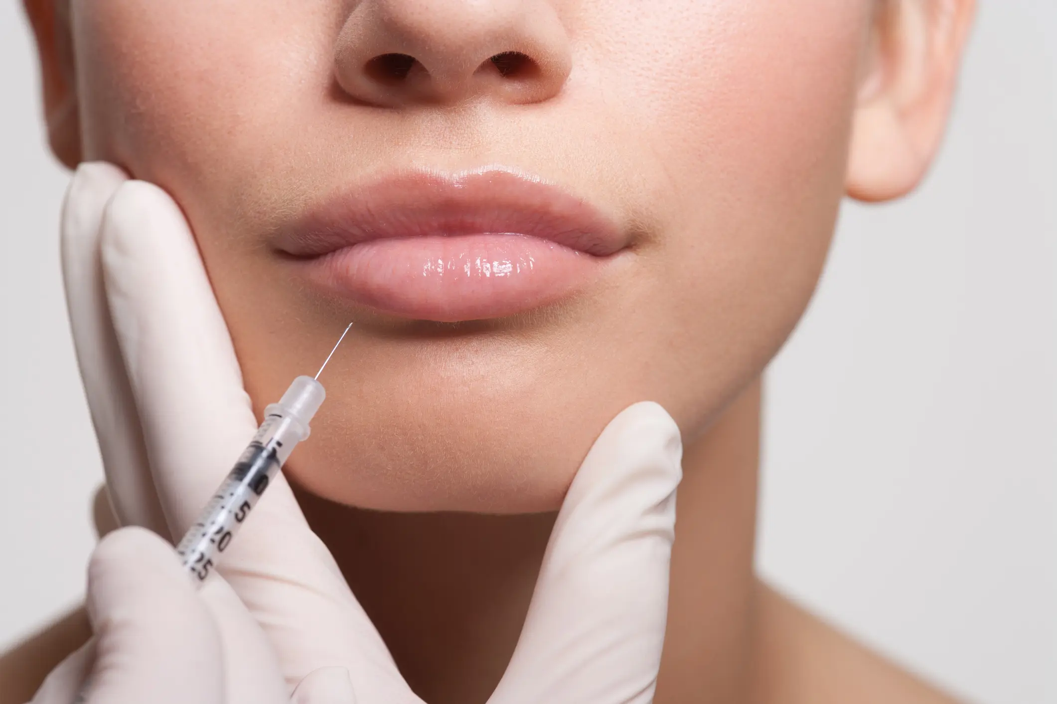 Lip filler injection procedure