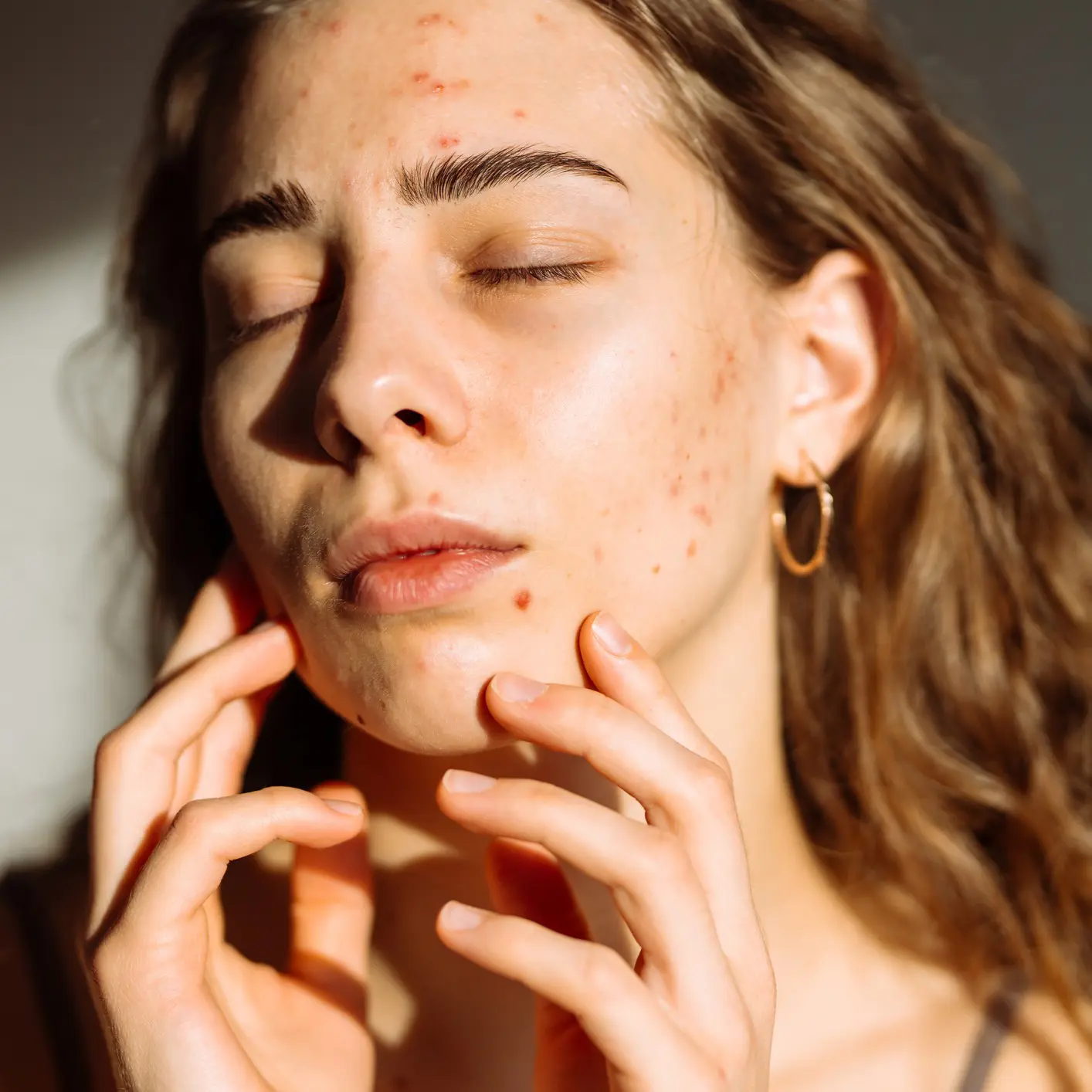 Woman with acne touching her face