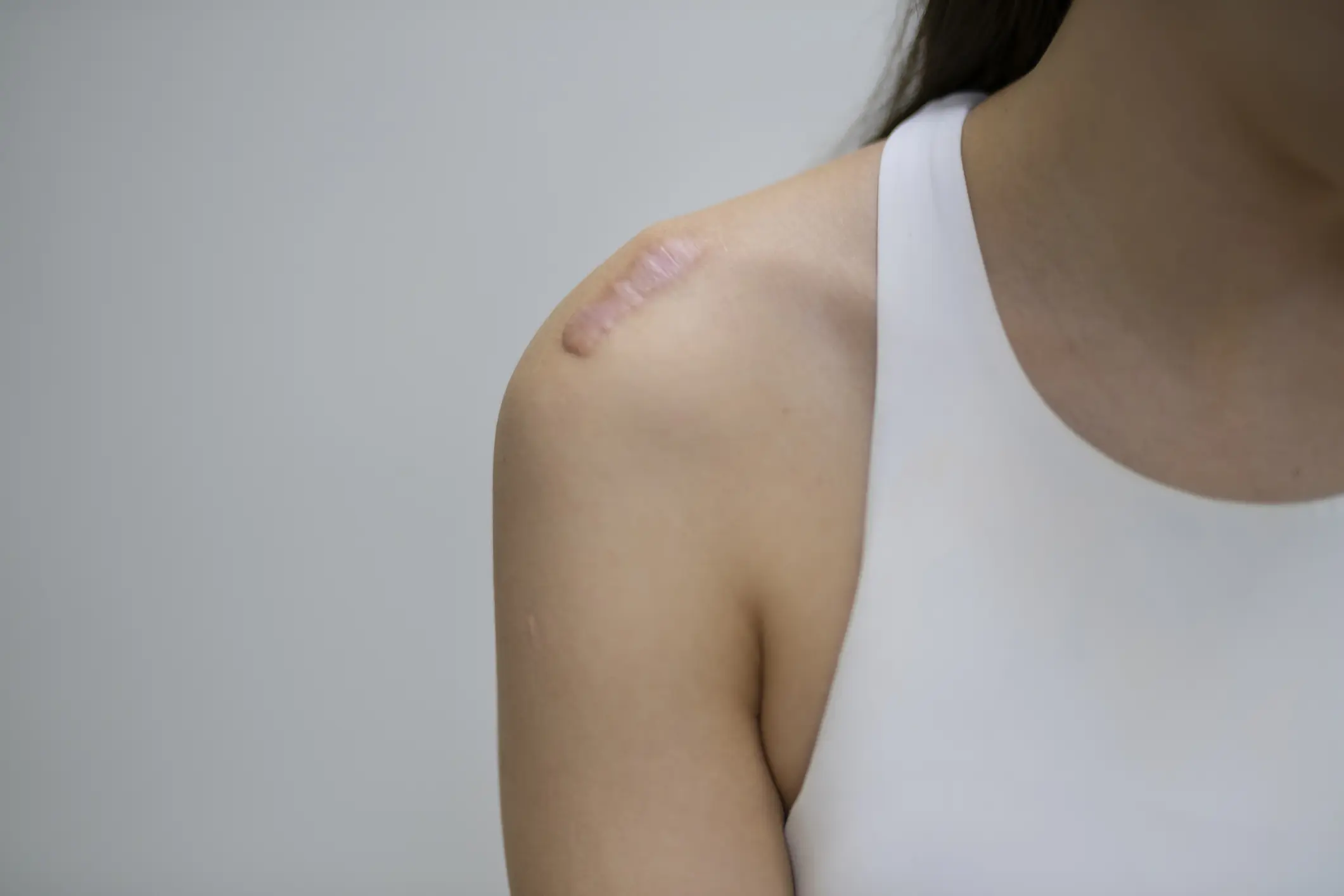 Woman's shoulder scar with light background