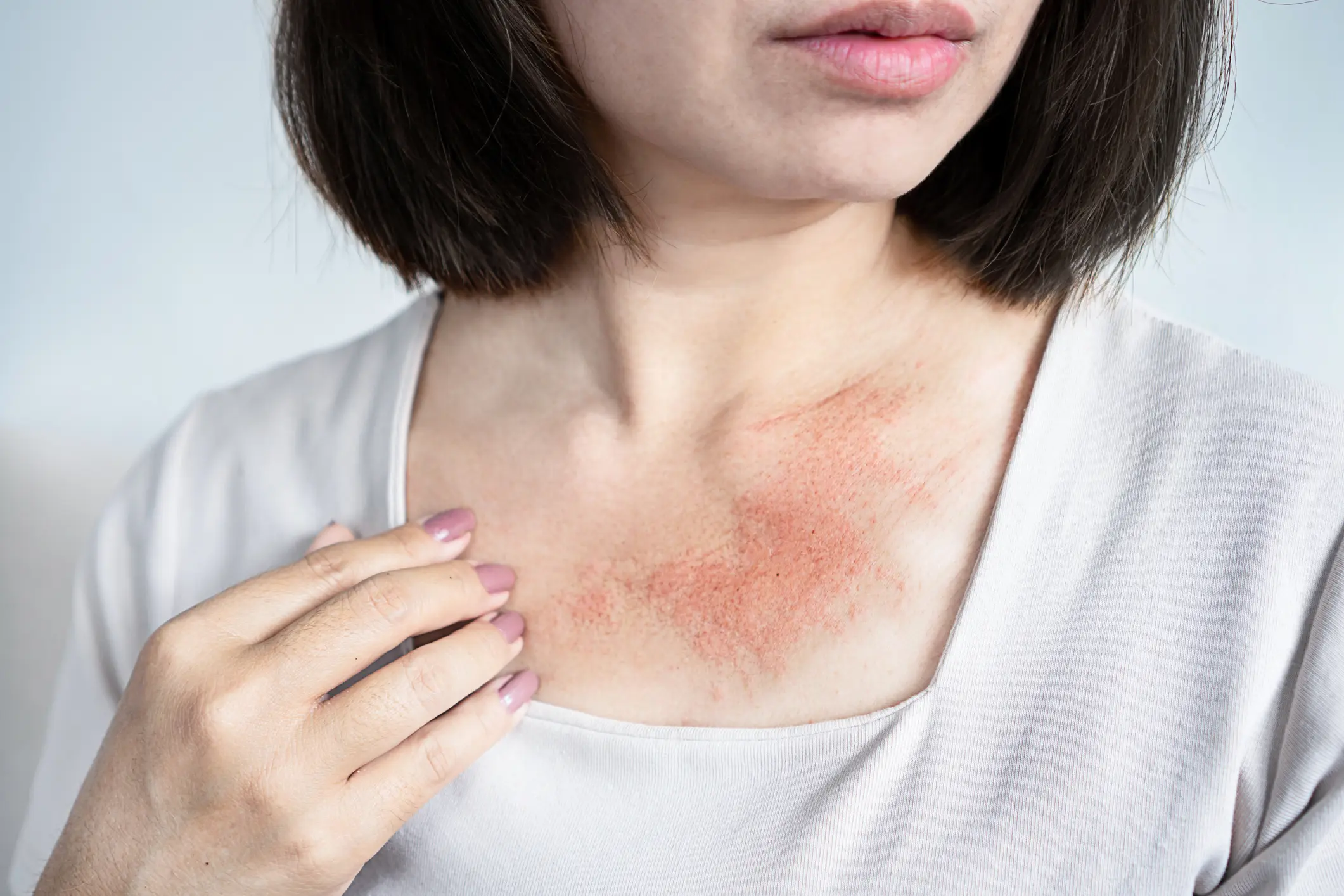 Skin rash on woman's chest
