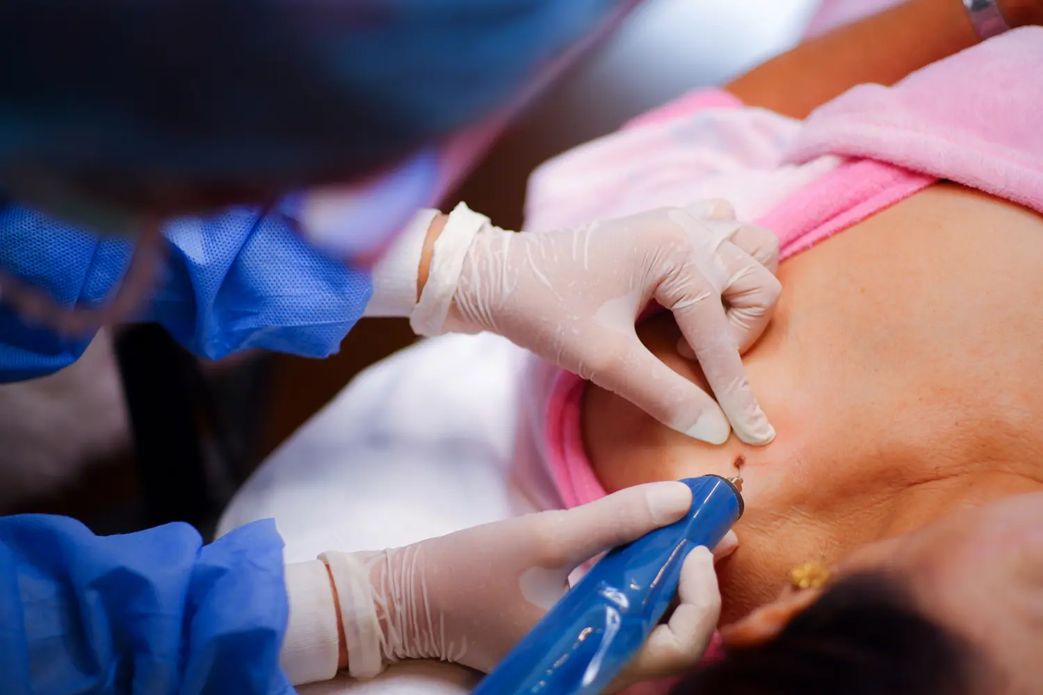 Doctor performing skin treatment