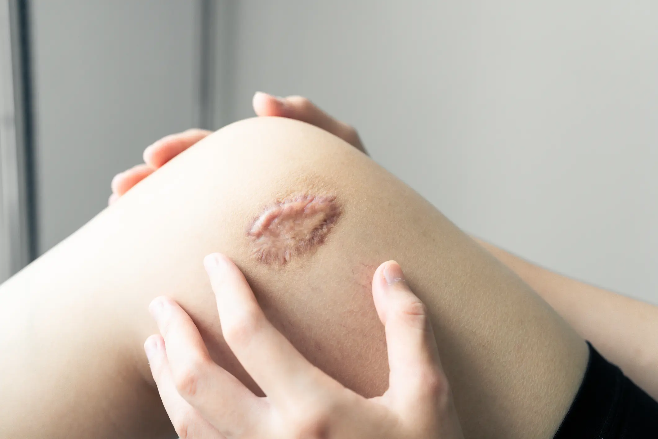 Close-up of knee scar