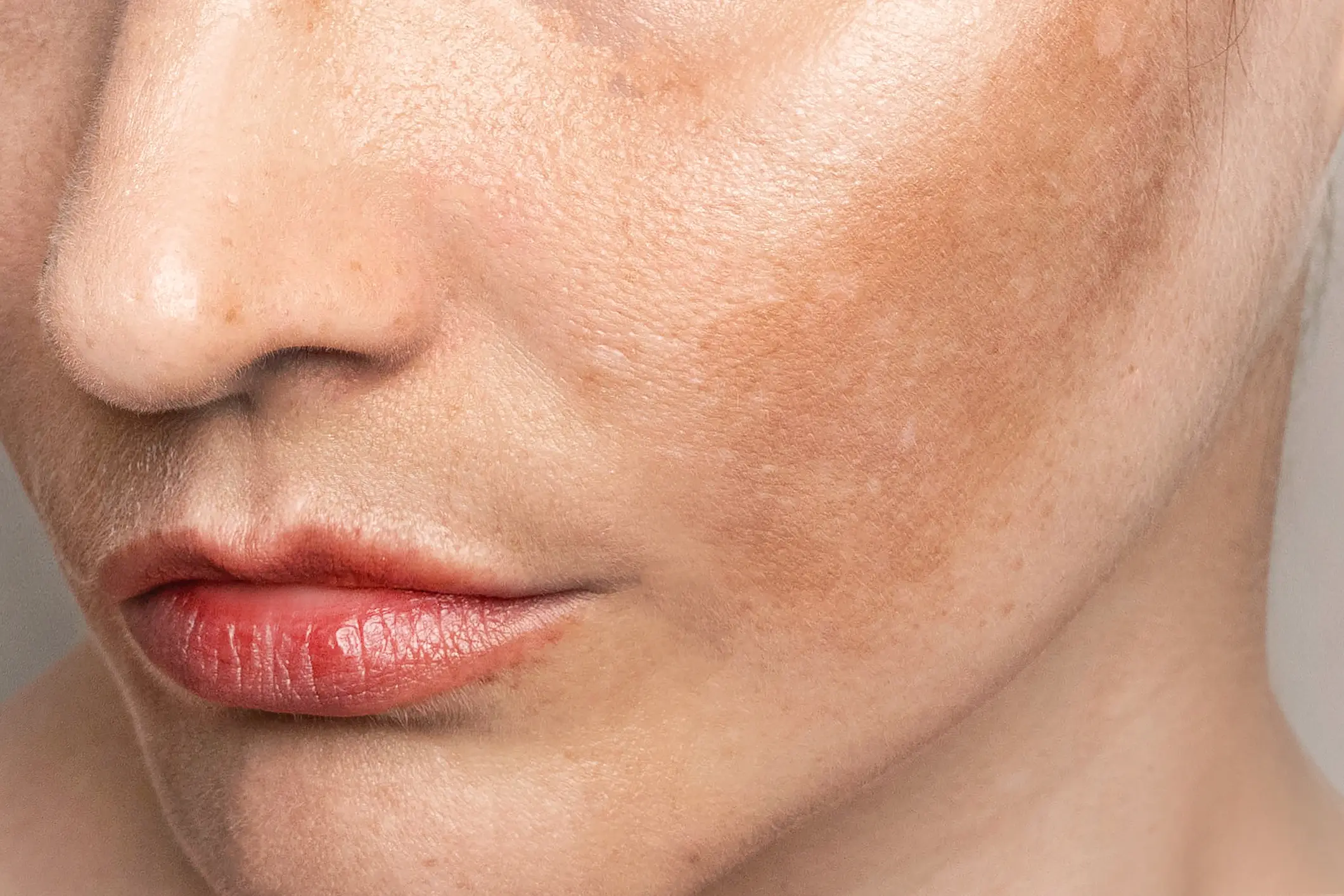 Woman's cheek showing skin pigmentation.