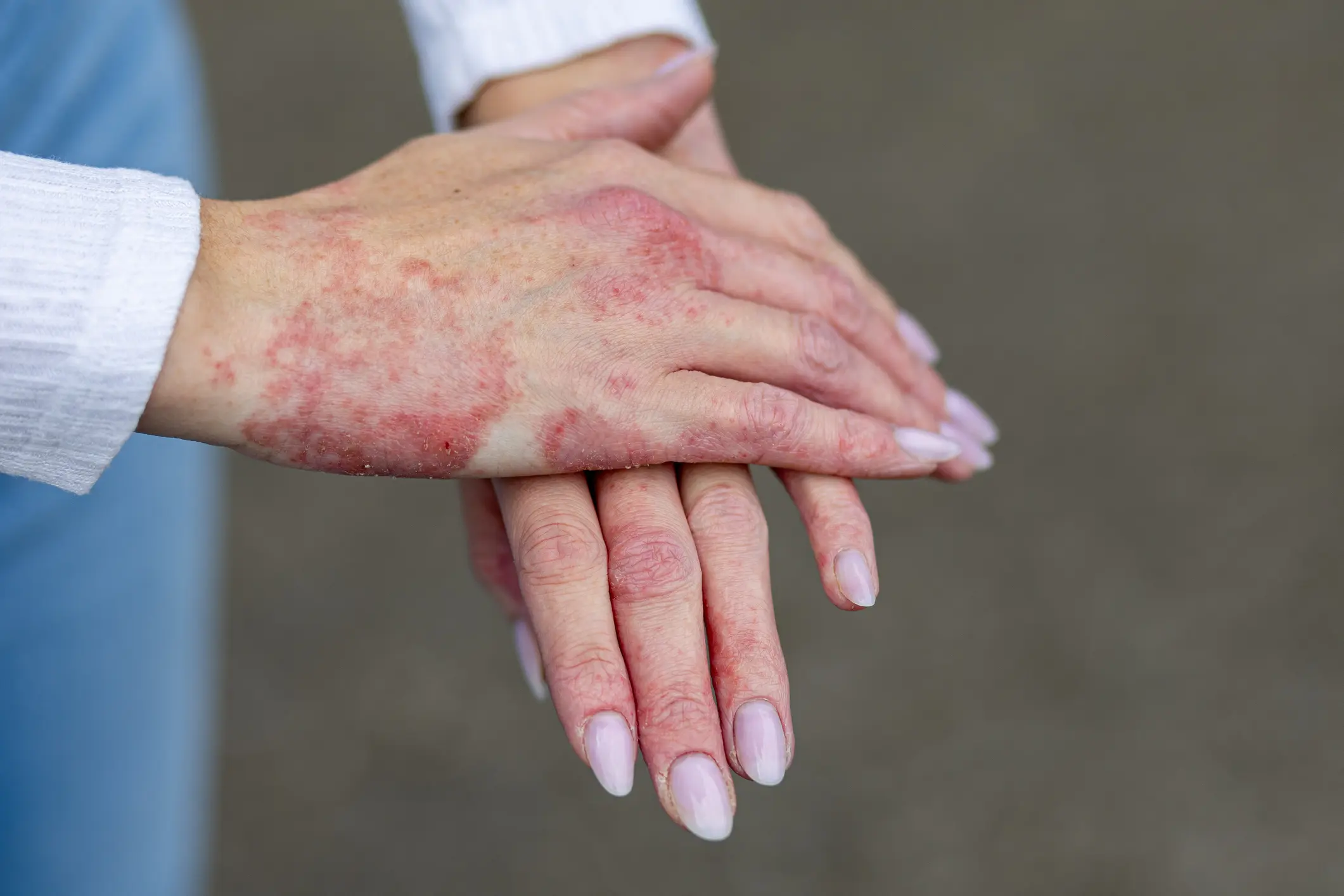 Skin condition on person's hands