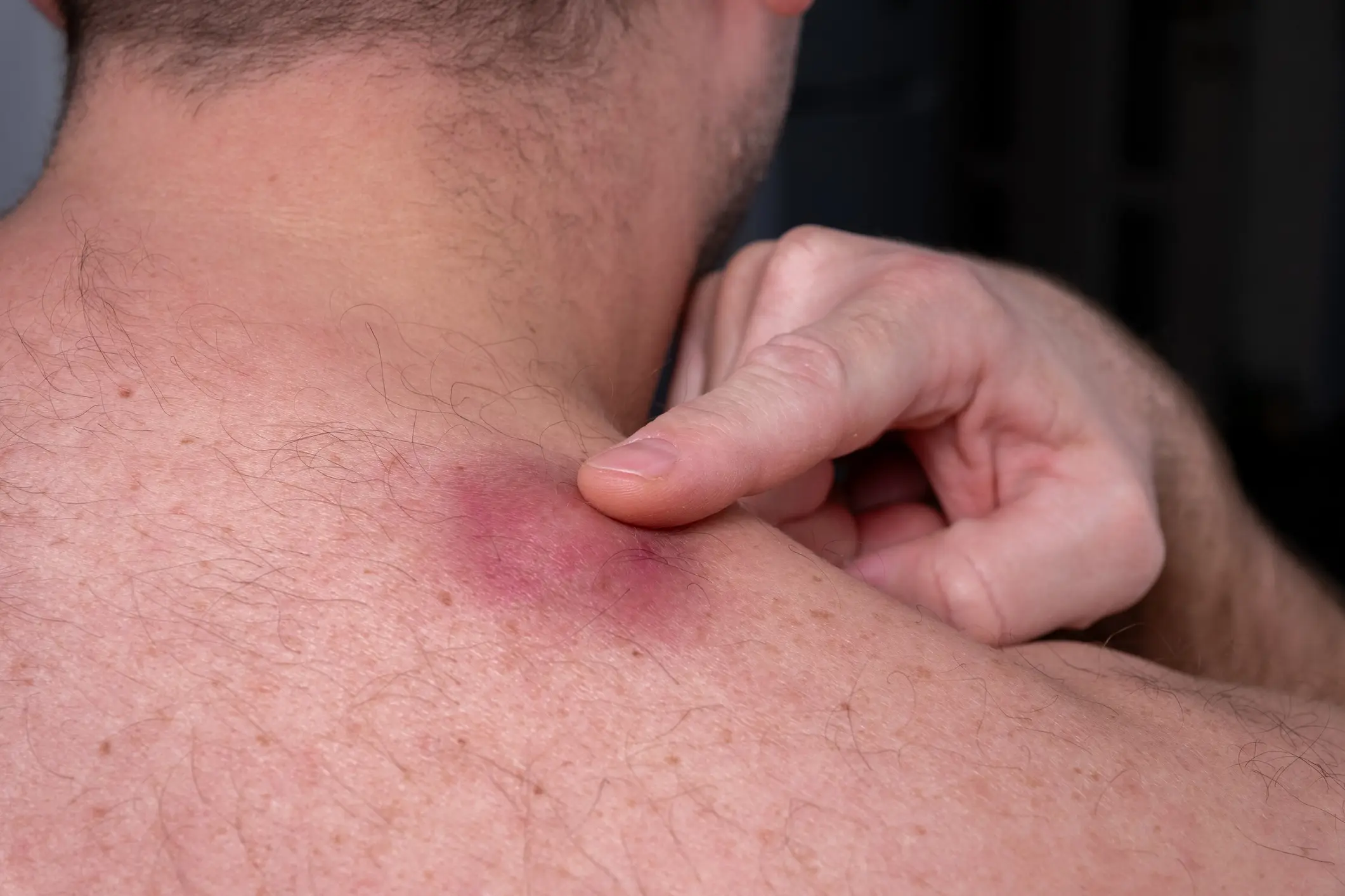 Red skin irritation on shoulder