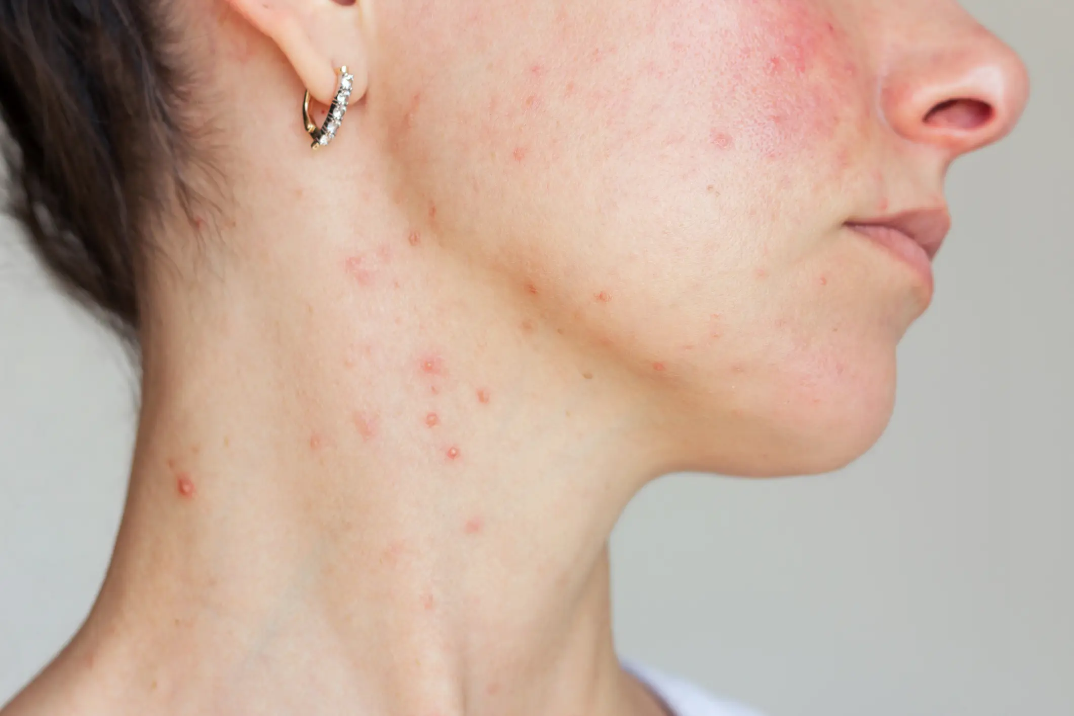 Close-up of facial skin blemishes