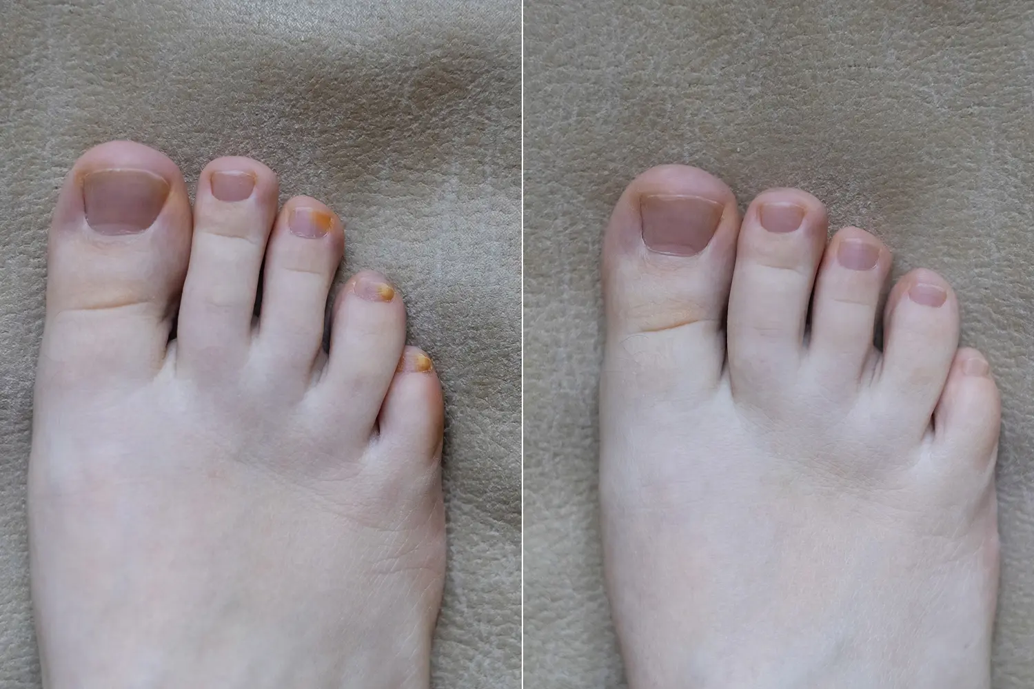 Toenail fungus treatment before and after