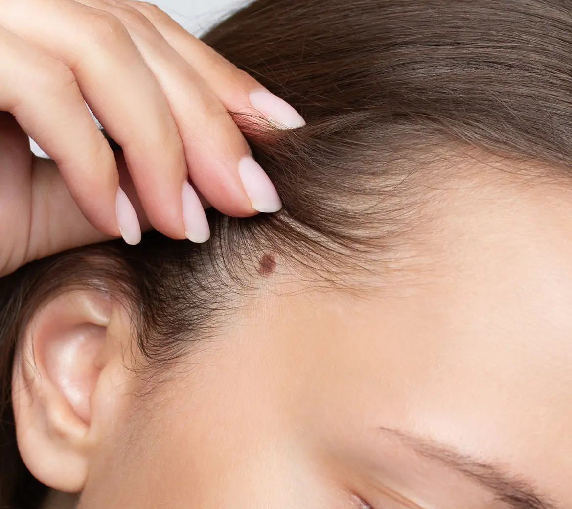Close-up of a mole on scalp